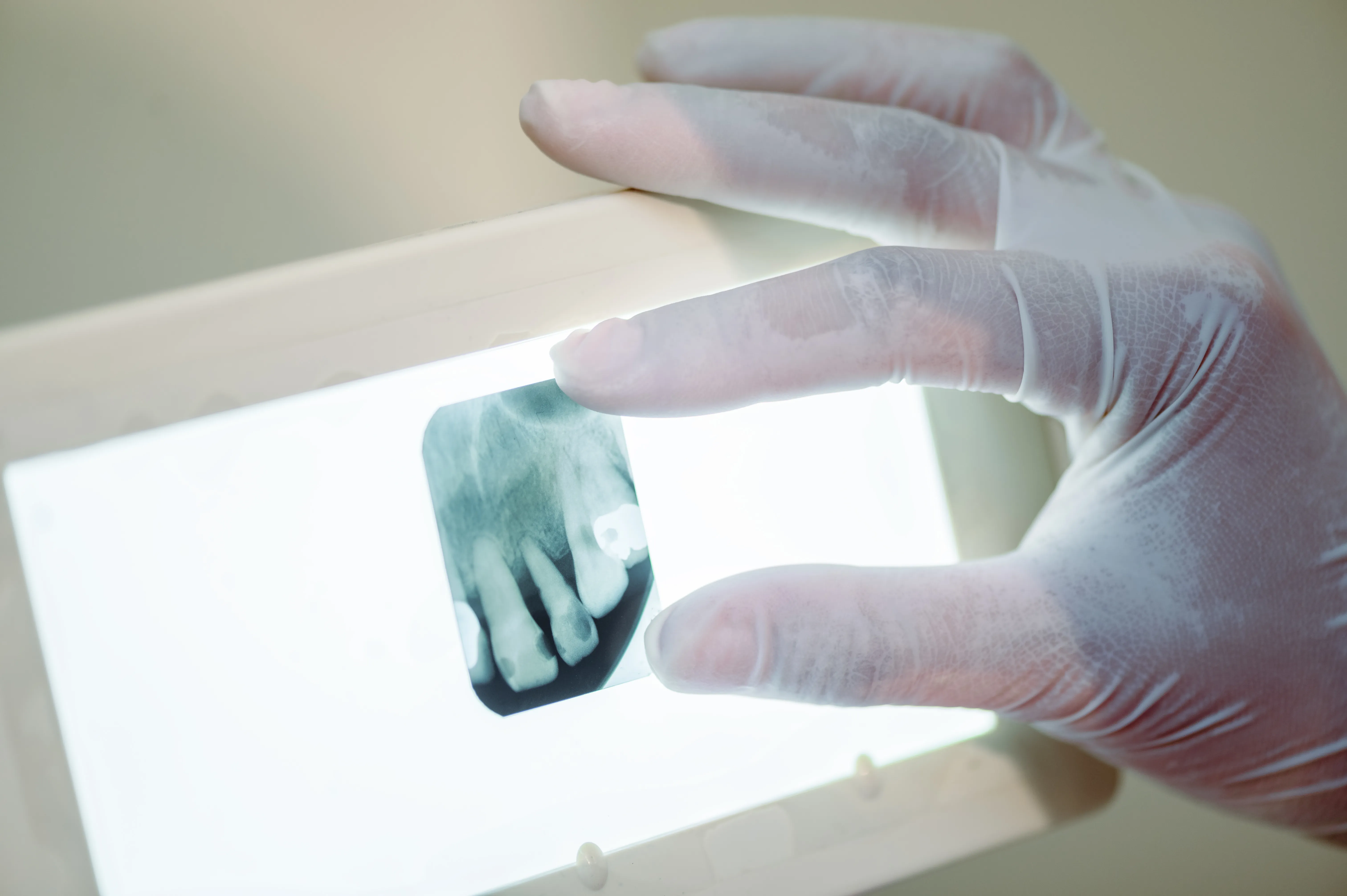 Radiografía digital en estudio periapical dental que permite observar caries profundas, infecciones óseas y estructuras dentales con gran detalle.